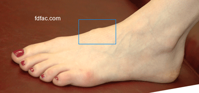 bump on top of foot | Bone, Joint and Ligament Problems ...